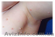 Видалення папілом, пігментних неусів  - <ro>Изображение</ro><ru>Изображение</ru> #1, <ru>Объявление</ru> #263944