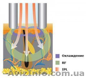ЭЛОС эпиляция в Нежине - <ro>Изображение</ro><ru>Изображение</ru> #1, <ru>Объявление</ru> #1376830