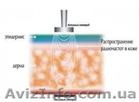 Радиочастотный лифтинг кожи (омоложение) - <ro>Изображение</ro><ru>Изображение</ru> #1, <ru>Объявление</ru> #1376832