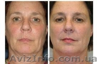 Радиочастотное омоложение (лифтинг кожи) - <ro>Изображение</ro><ru>Изображение</ru> #2, <ru>Объявление</ru> #1595828