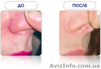 Удаление сосудистых сеточек лазером - <ro>Изображение</ro><ru>Изображение</ru> #2, <ru>Объявление</ru> #1595849