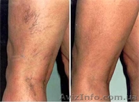 Удаление сосудистых сеточек лазером - <ro>Изображение</ro><ru>Изображение</ru> #3, <ru>Объявление</ru> #1595849