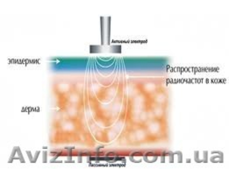 Радиочастотный лифтинг кожи (омоложение) - <ro>Изображение</ro><ru>Изображение</ru> #1, <ru>Объявление</ru> #1376832