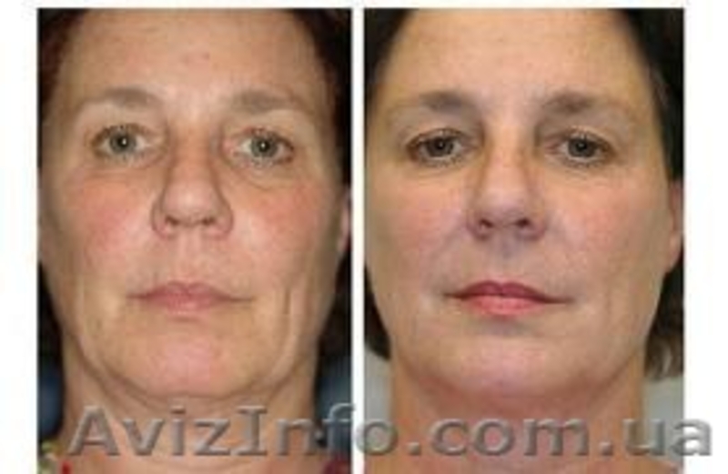 Радиочастотное омоложение (лифтинг кожи) - <ro>Изображение</ro><ru>Изображение</ru> #2, <ru>Объявление</ru> #1595828