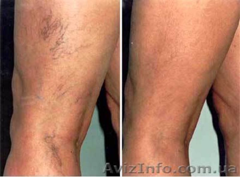 Удаление сосудистых сеточек лазером - <ro>Изображение</ro><ru>Изображение</ru> #3, <ru>Объявление</ru> #1595849